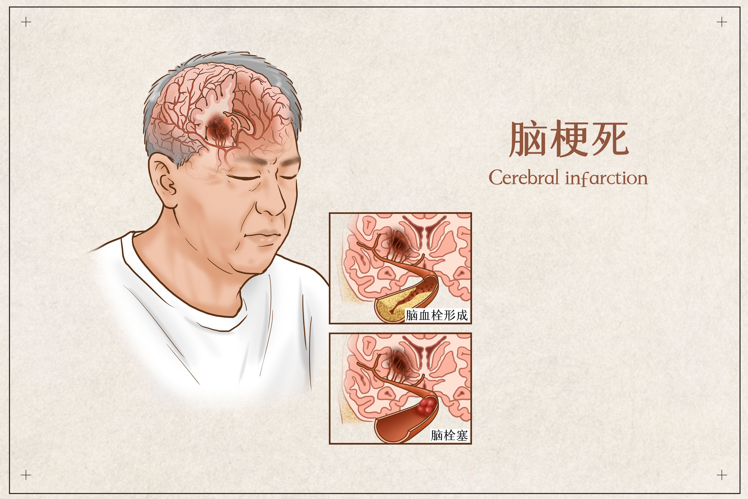 脑梗卡通图片