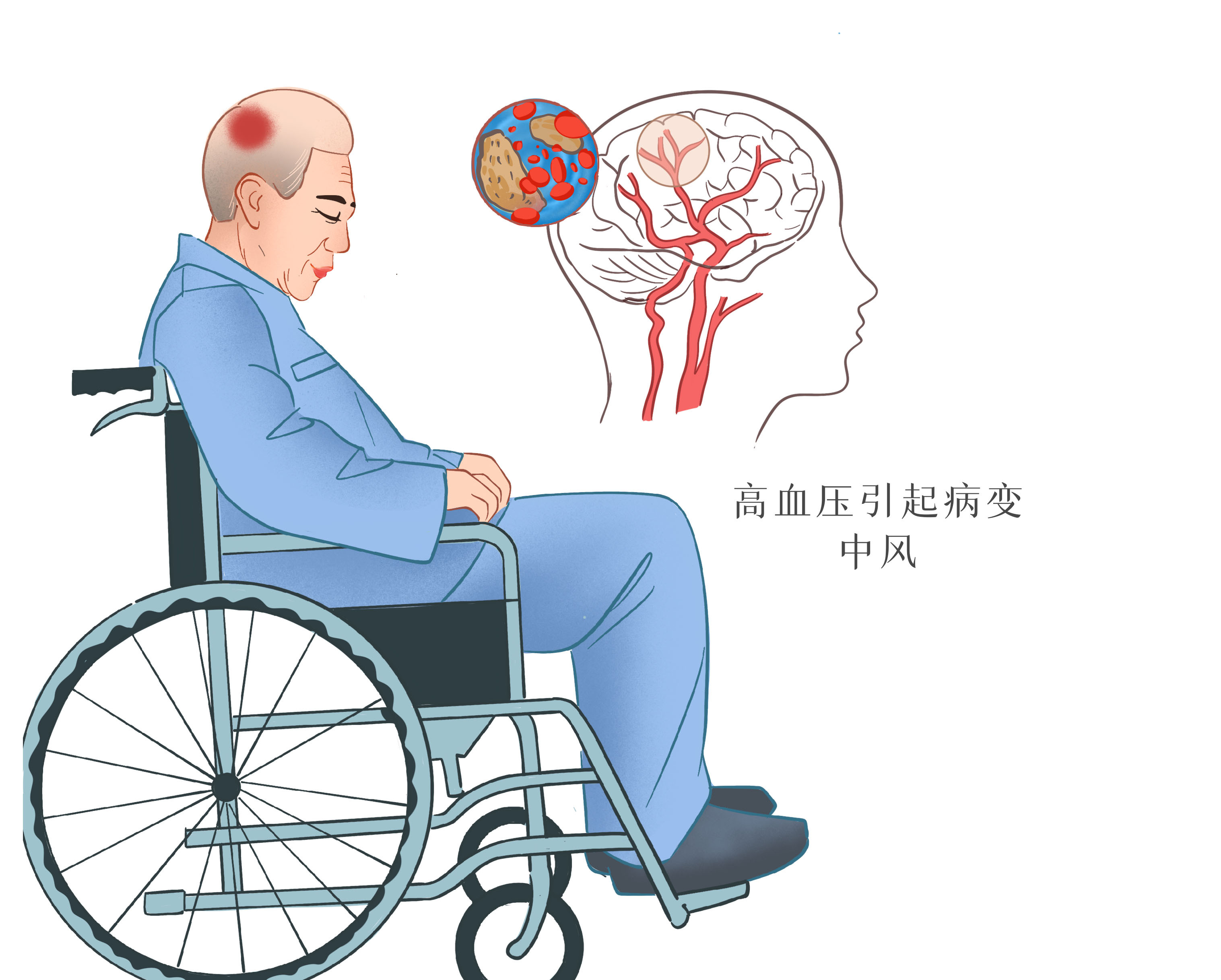 95%的中风后遗症患者会选择针灸推拿来作为康复治疗