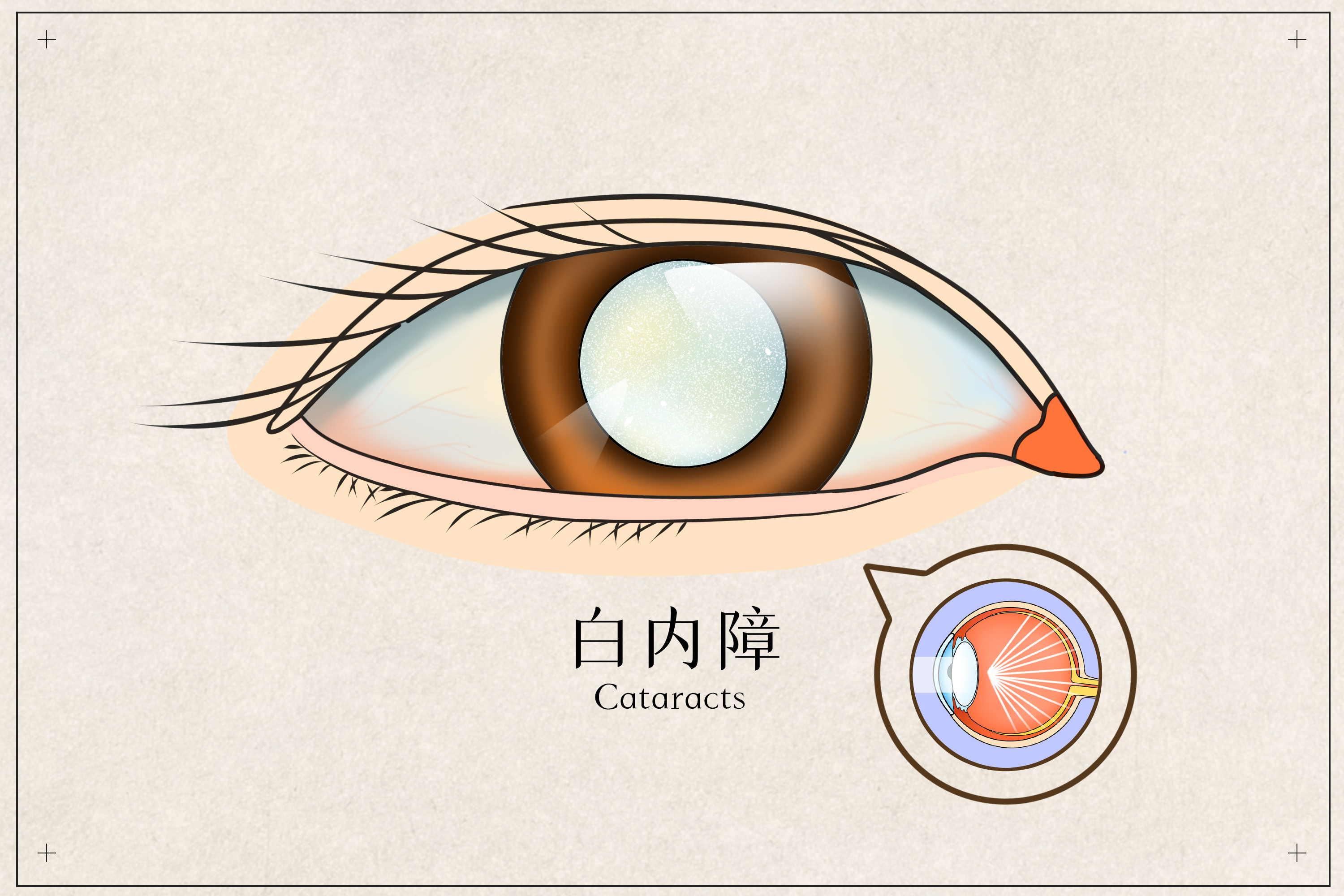 治疗白内障手术，你想知道什么？眼科专家方健回答你