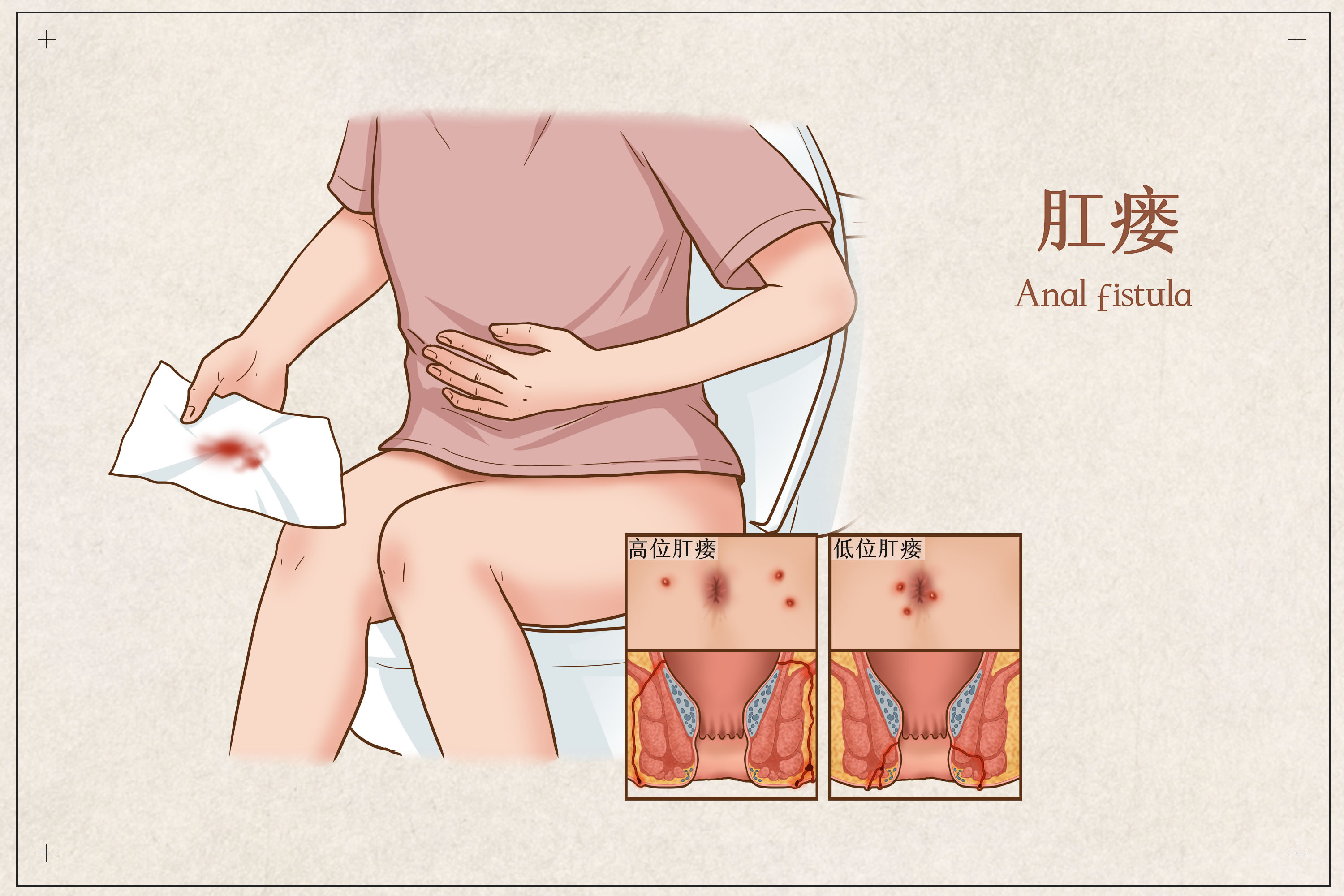 防治肛瘘中的常见问题，中医科专家朱赟为您解答