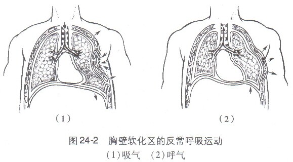 暴力直接作用于肋骨,可使肋骨向内弯曲折断,前后挤压暴力使肋骨腋段向
