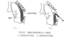 慢性脓胸的治疗