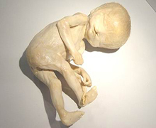 胎儿畸形概述