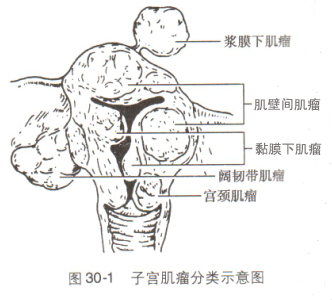 疾病搜索 妇产科 子宫肌瘤     (3)黏膜下肌瘤(submucous myoma):占10