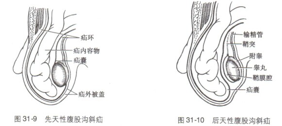 腹股沟疝的病因