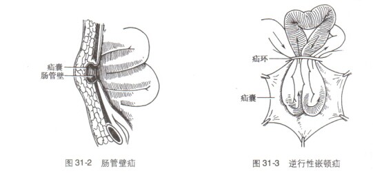 5.儿童疝因疝环组织一般比较柔软,嵌顿后很少发生绞窄.