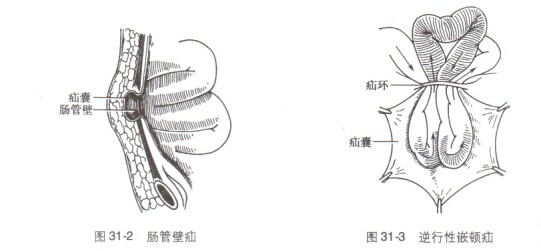 腹外疝的解剖图片图片