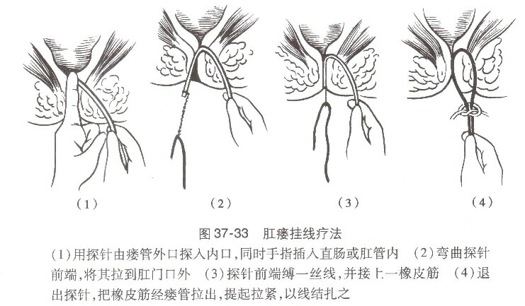 疾病搜索 外科 肛瘘 手术在骶管麻醉或局麻下进行,将探针自外口