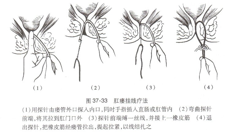 肛瘘挂线动画演示图片