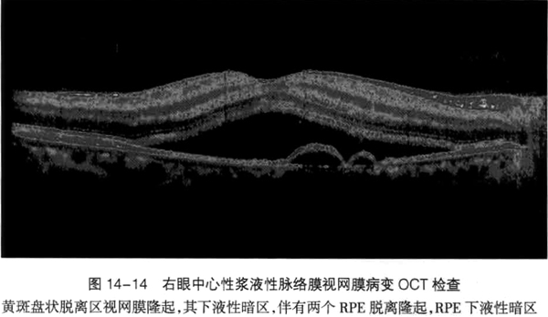 中心性浆液性脉络膜视网膜病变的临床表现