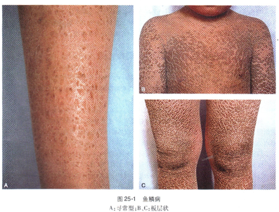 鱼鳞病的临床表现 世界医疗网 鱼鳞病的临床表现 世界医疗网
