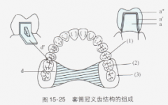 套筒冠义齿的组成