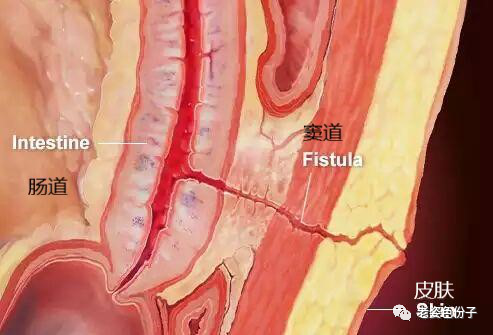 导致肠瘘的四大原因