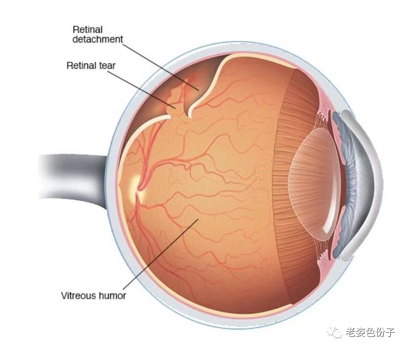 视网膜脱离?不要急，尽快就医最重要