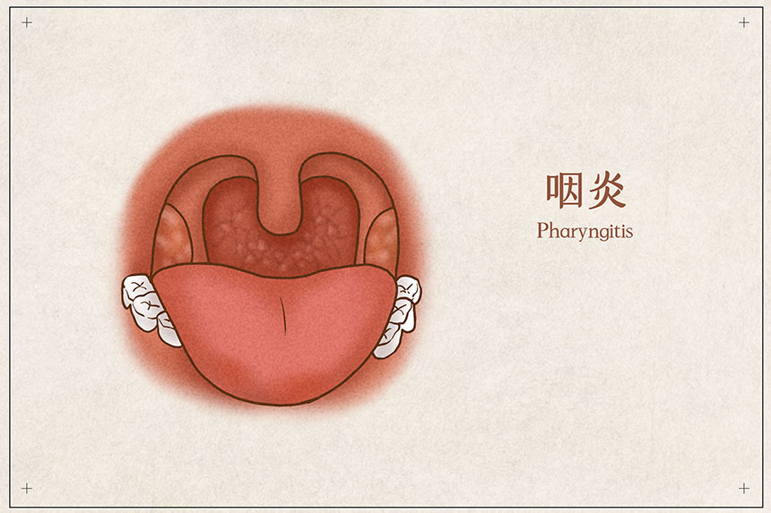 什么样的人易患慢性咽炎