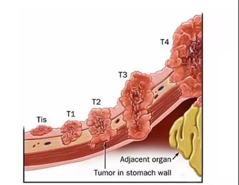 改变战术，战胜中晚期胃癌