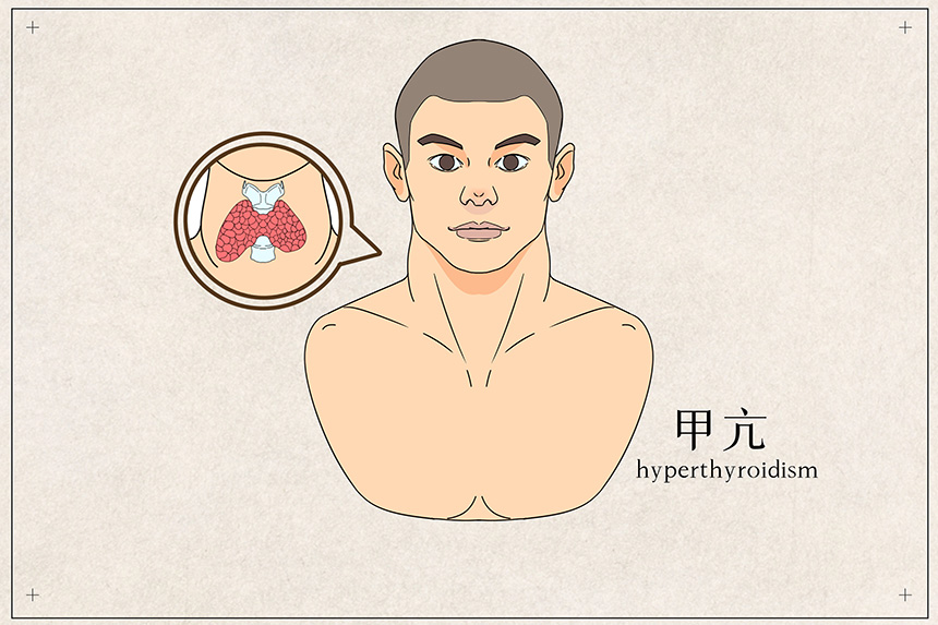 年关将至，甲亢患者饮食方面应该注意什么？