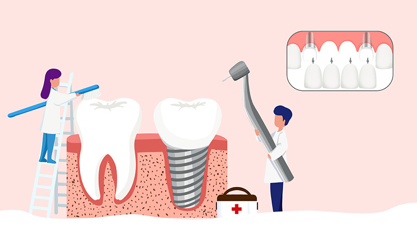 牙齿种植后如何保健