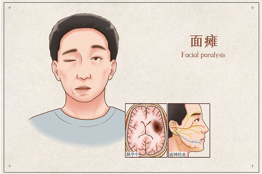 “四管齐下”治疗面瘫