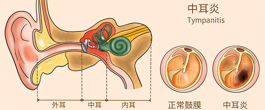 慢性化脓性中耳炎需手术治疗吗？