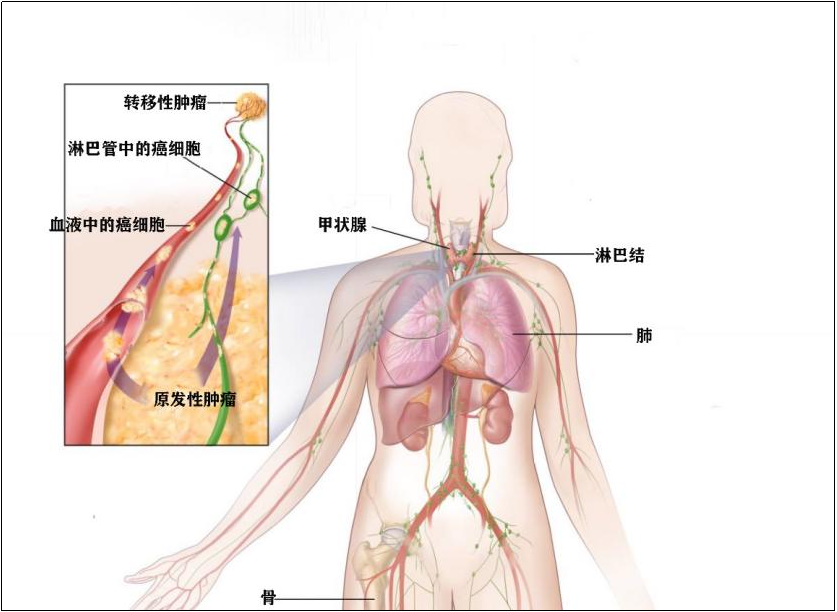 甲状腺癌会转移吗还有救吗？