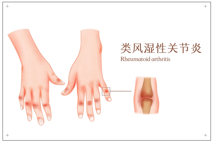 倪立青教授：求医莫走弯路