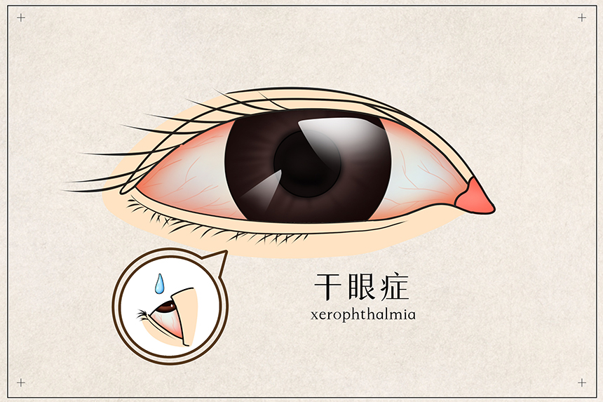 准分子激光手术的术后护理该注意什么？